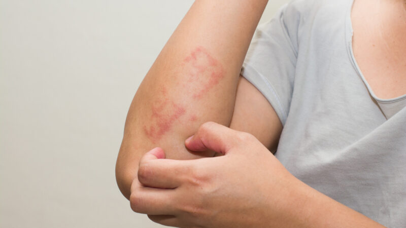 Skin Allergies – Types, Symptoms, Causes, and Diagnosis